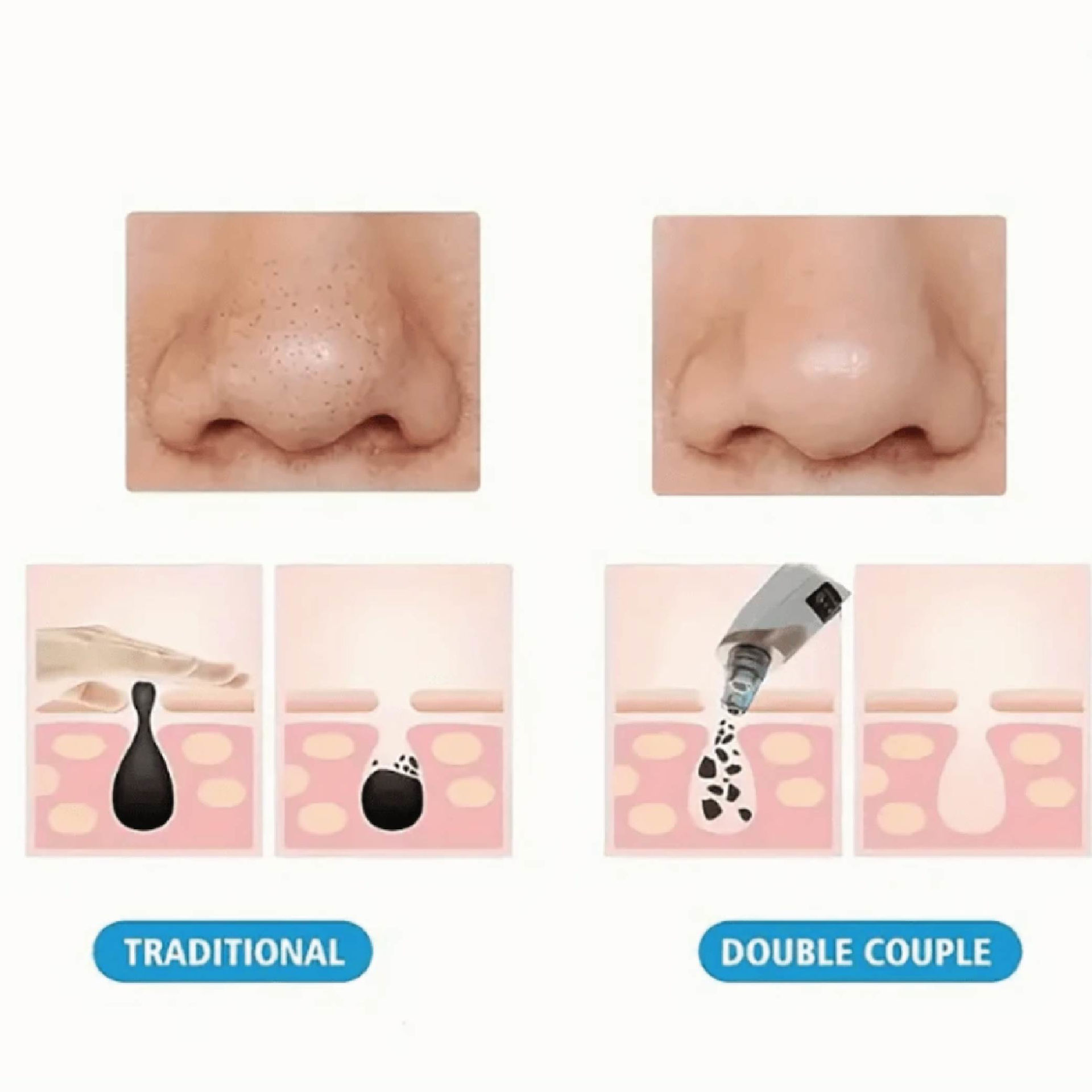 دستگاه مکنده جوش هیوندای (HYUNDAI Blackhead Remover)